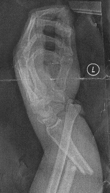 broken_arm.jpg